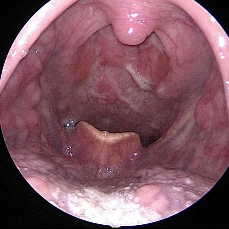 땡큐서울의원_구인두암항암치료후