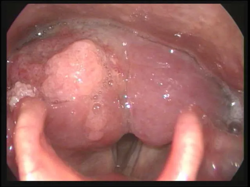 땡큐서울의원_하인두암후두내시경