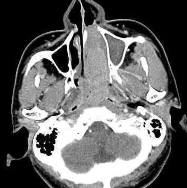 땡큐서울의원_비인두암CT