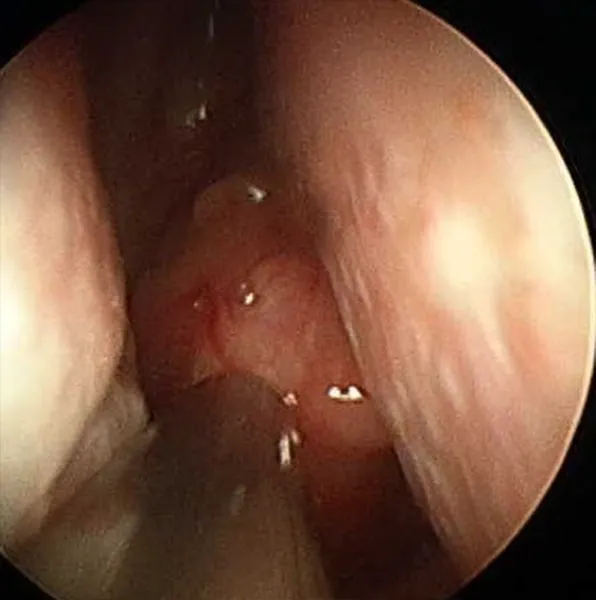 땡큐서울의원_비인두암내시경