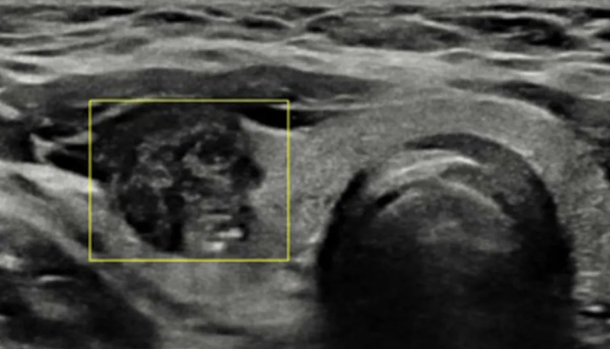 땡큐서울의원_갑상선결절 초음파 이미지