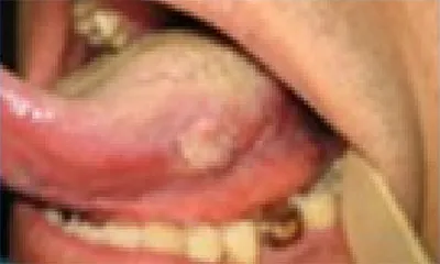 땡큐서울의원 구강암 종류 - 설암