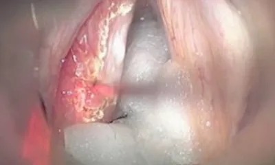 초기 후두암 레이저수술 장면