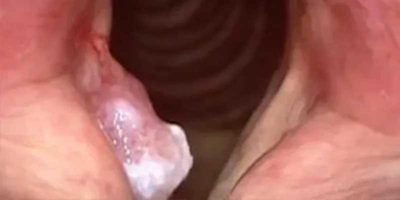 땡큐서울의원 후두암 내시경