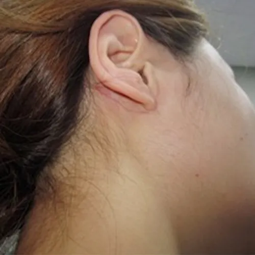 땡큐서울의원 이하선 V자형 수술법 - 수술 전/과정