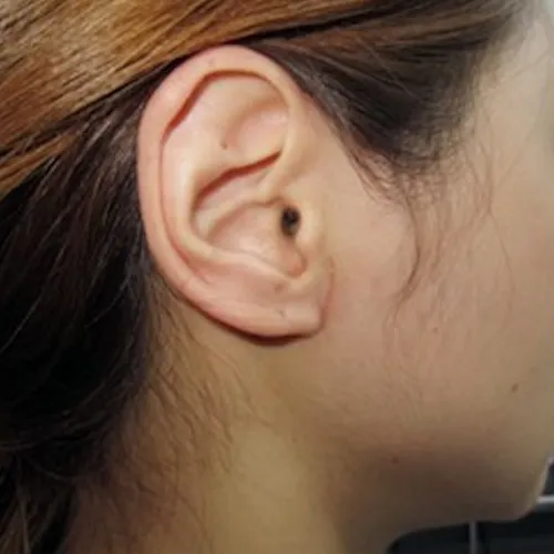 땡큐서울의원 이하선 V자형 수술법 -  수술 후 흉터