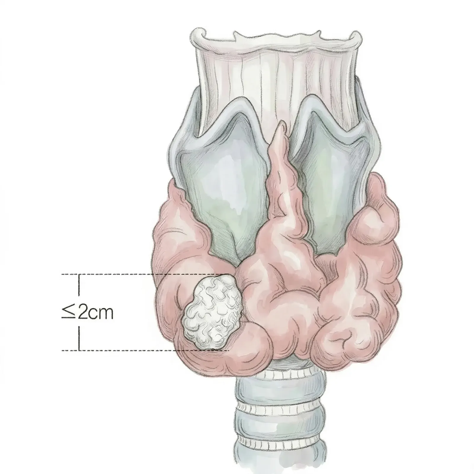 땡큐서울의원 갑상선암 T1 병기