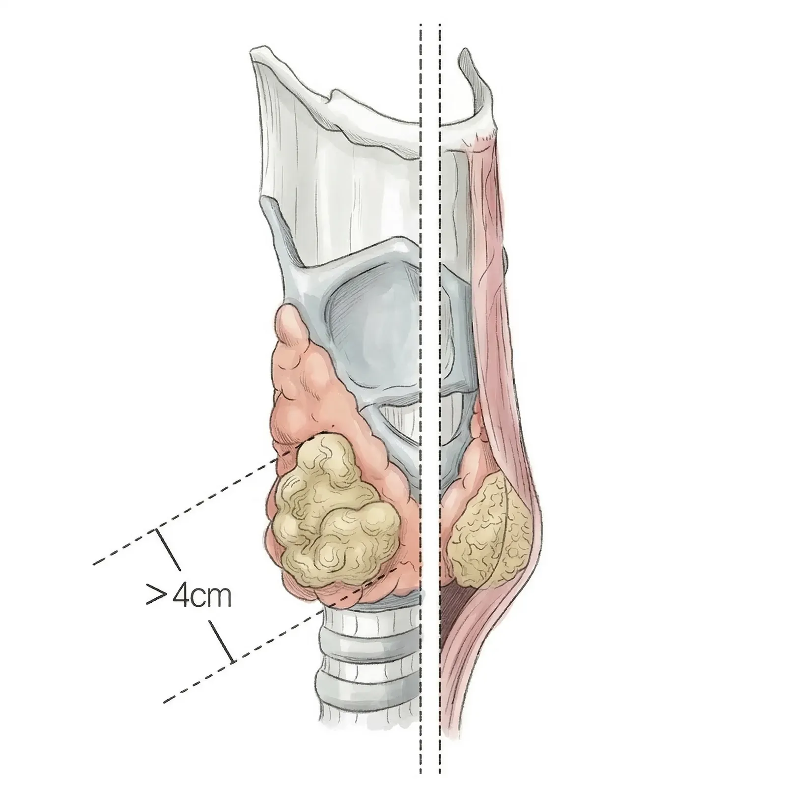땡큐서울의원 갑상선암 T3 병기