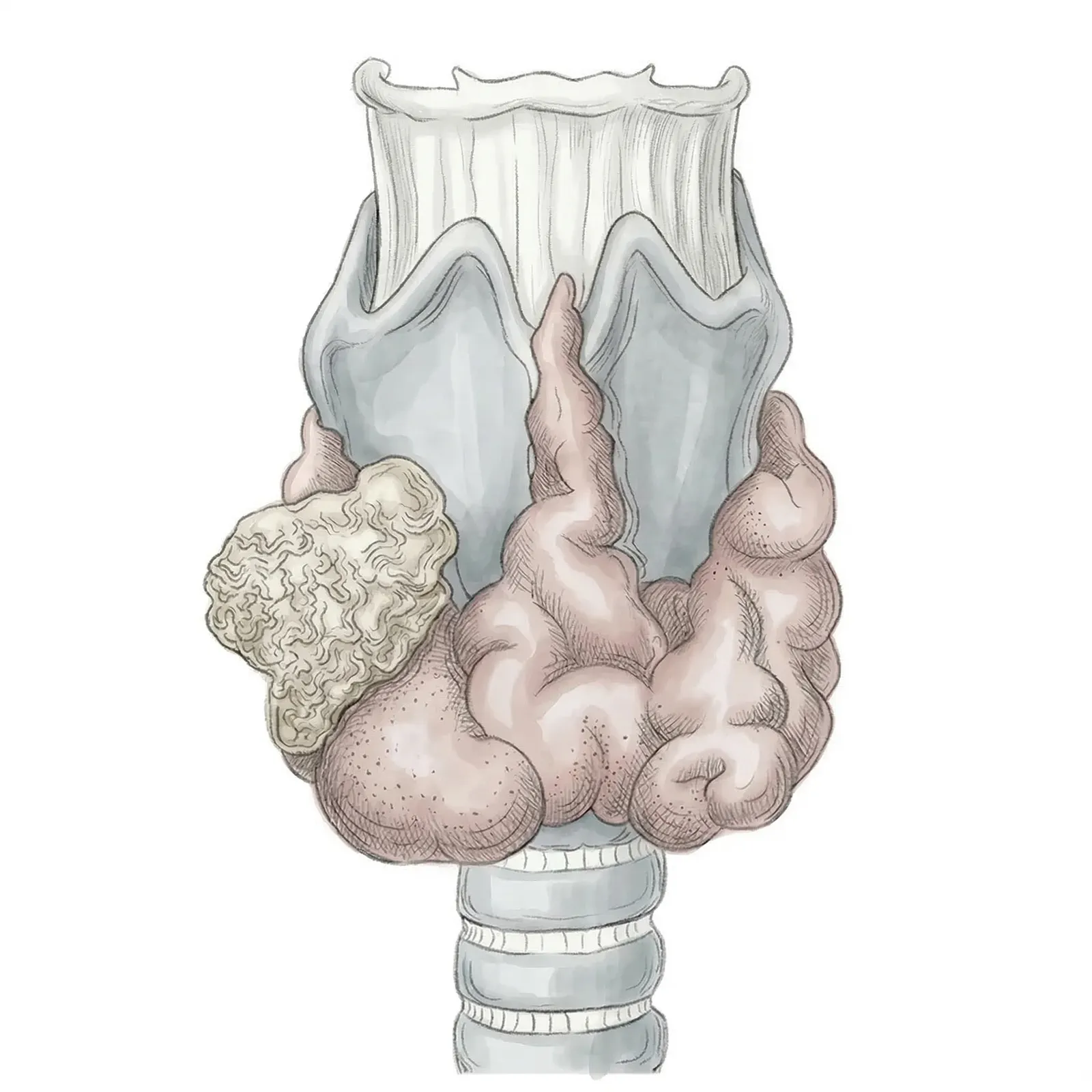 땡큐서울의원 갑상선암 T4a 병기 (정면)