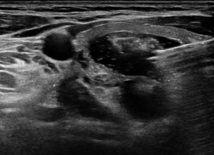 땡큐서울의원 갑상선 양성종양 CT소견 (횡단면)